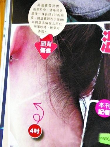 溫嘉蓉展示傷口。