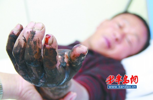 鄒先生的左手被蛇咬傷后明顯腫脹。