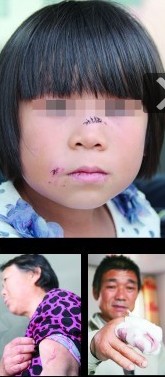 6歲女童上學路上遭瘋狗啃臉 20人合力打死惡狗