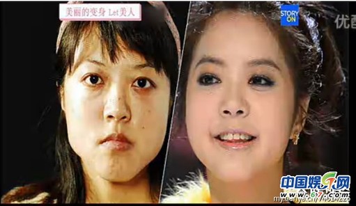 多圖劇透韓國整容節(jié)目《LET 美人》近幾期，最愛小V臉，人瘦就能美