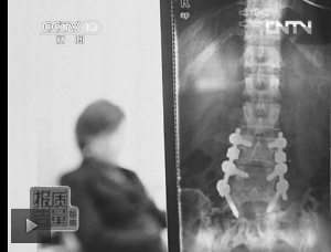 圖1：教練按壓導(dǎo)致學(xué)員腰椎間盤突出。（央視截屏）