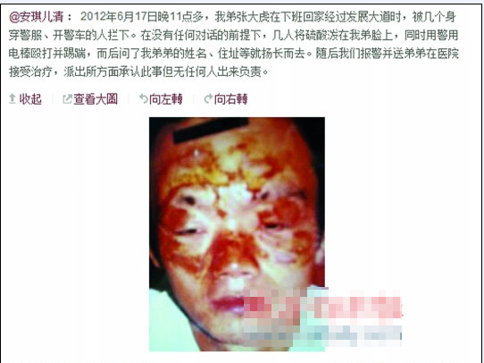 張大虎的姐姐將弟弟面部燒傷一事發(fā)上微博，引發(fā)網(wǎng)友廣泛關(guān)注。